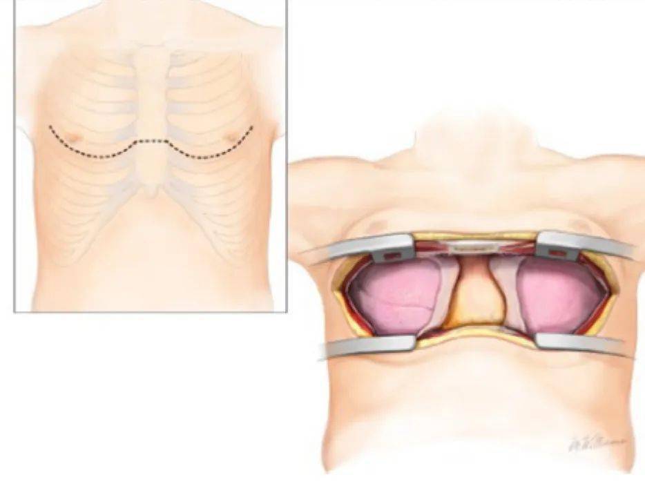 华西全球首例不开胸完成双肺移植对话救治团队