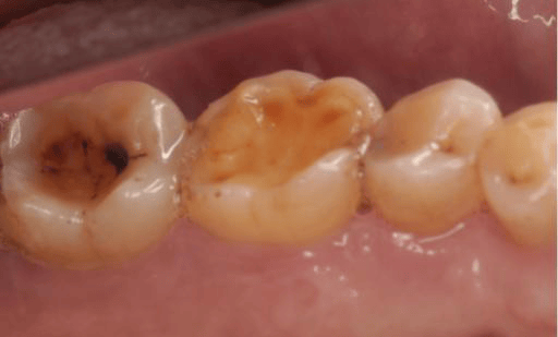 "酸牙,倒牙"别紧张——牙医带你认识牙本质敏感症