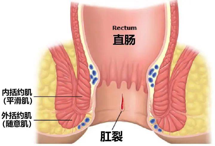 外痔不出血图片