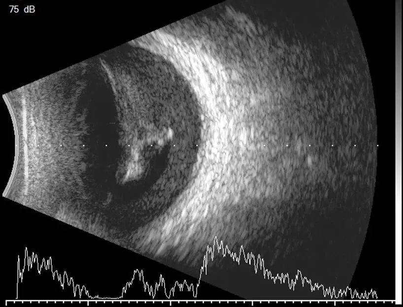 带您了解眼部b超