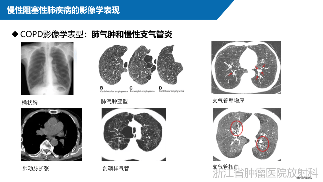 肿瘤影像专科微课堂慢性阻塞性肺疾病copd影像学评价与进展
