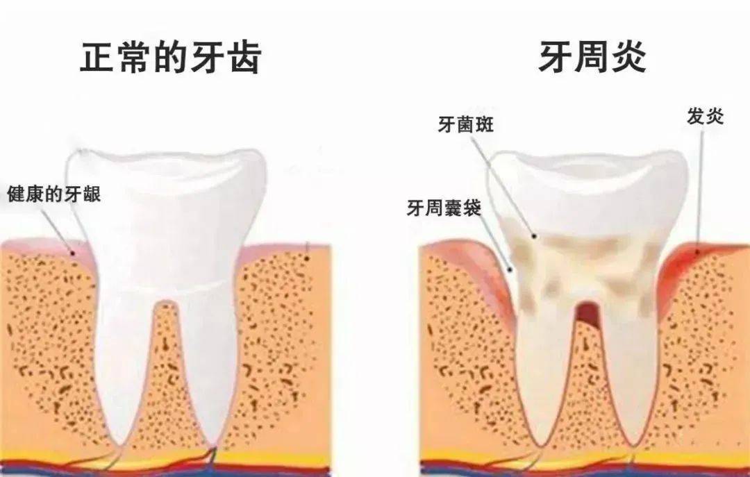 为什么会有牙齿咬合痛出现咬合痛怎么处理