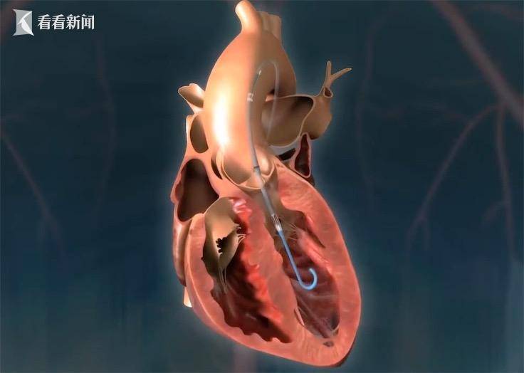 最高级别召回警告强生旗下一款心脏泵致死49人