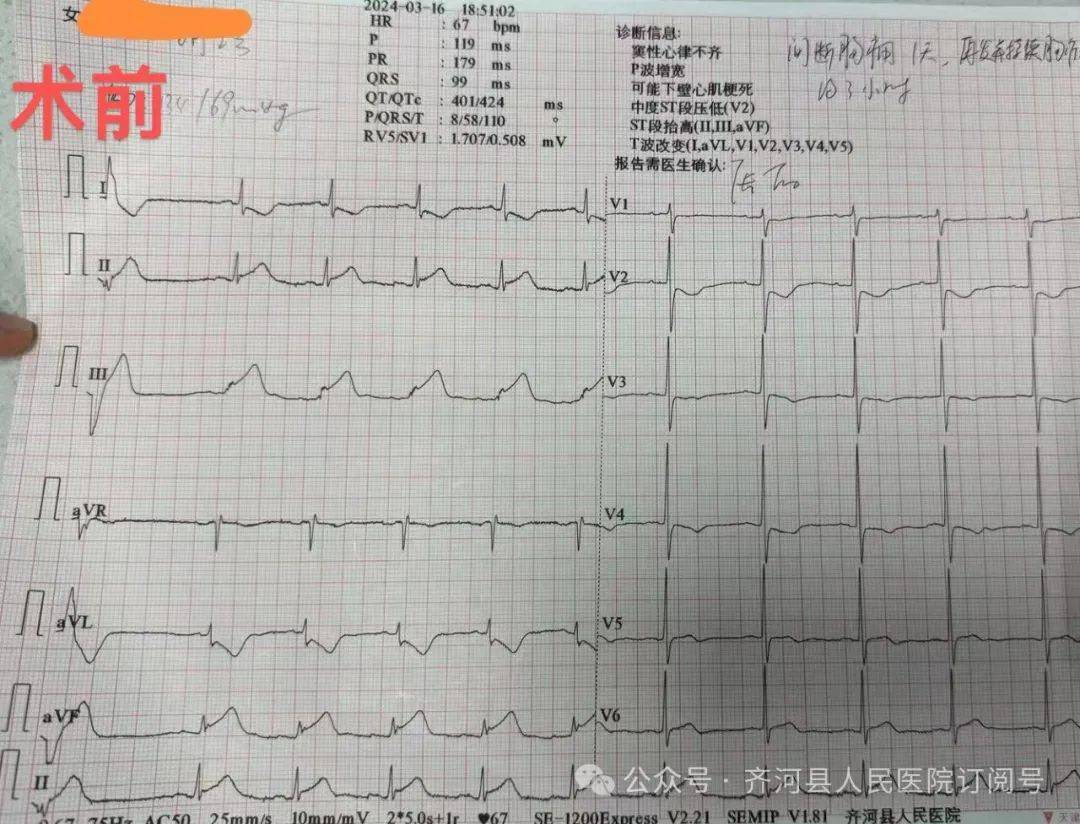 心电图检查提示 下壁导联st段抬高