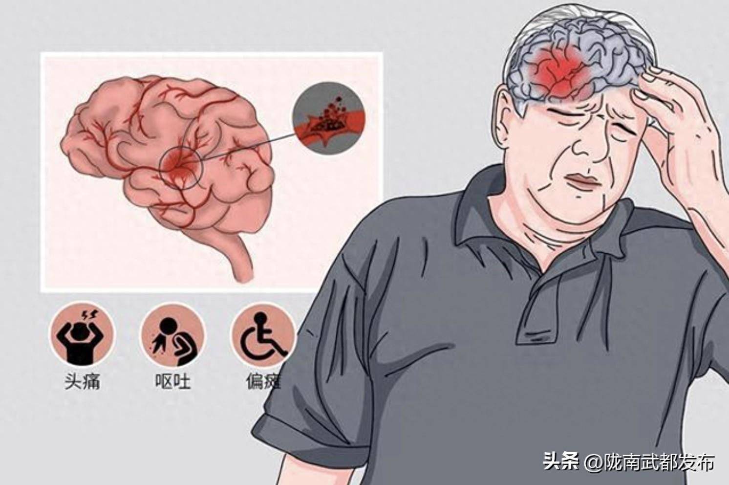 脑溢血遗传吗 来自搜狐网