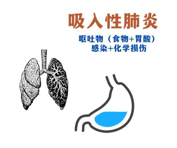 麻醉时出现呕吐的情况，还有呢，就是可以预防得吸入性肺炎这种并发症。