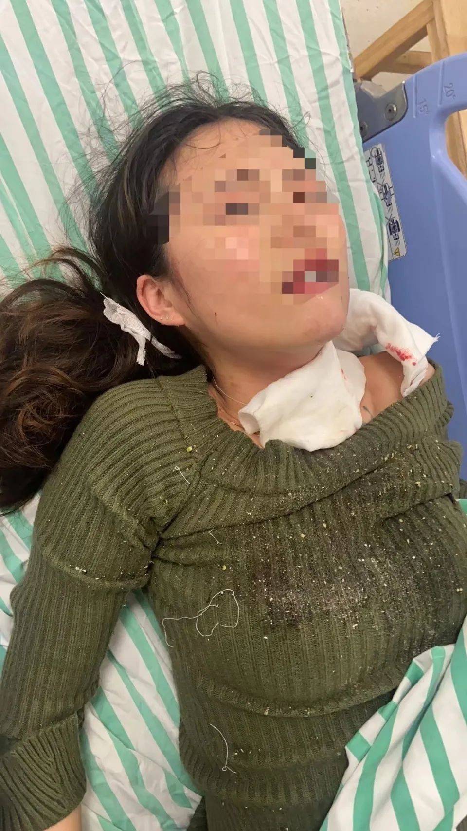 恐怖!浙江一女子就餐时卡式炉突然爆开!眼部被烧伤,当场"失明"!
