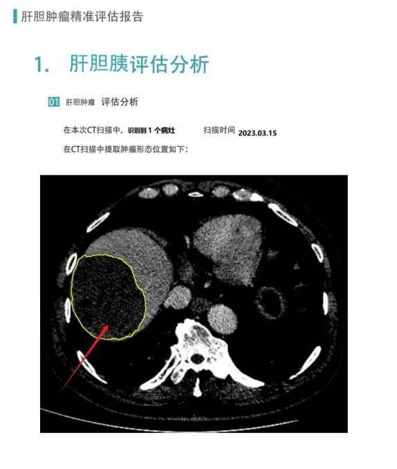 面对患者复杂的s7,s8段肝脏肿瘤病情,我院迅速启动mdt机制,集结肝胆胰