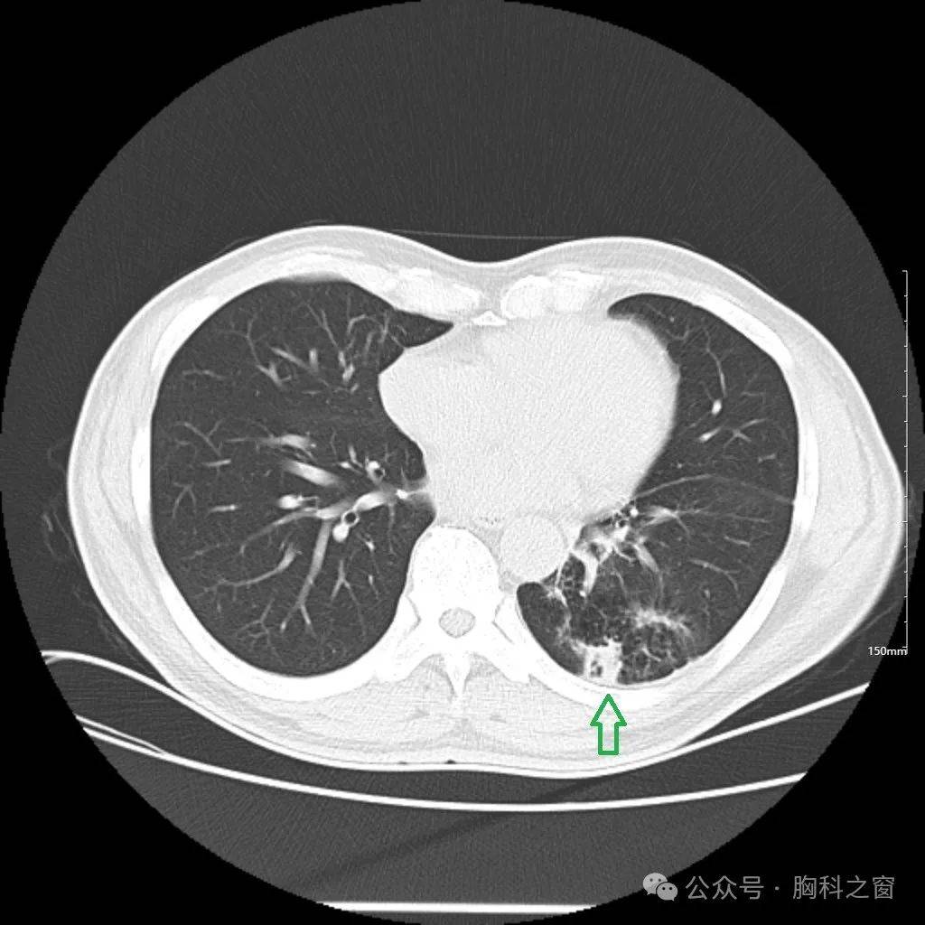 病毒性肺炎ct影像图片图片