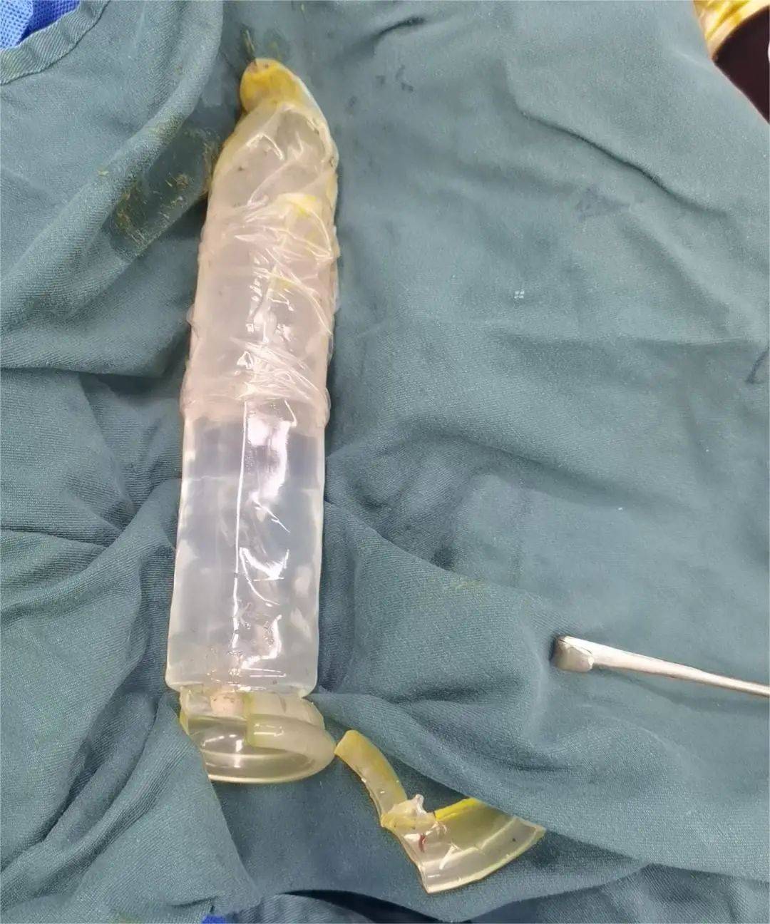 异物进去容易出来难结果,哪知道玩脱了,一个棒状玩具卡在直肠里取不