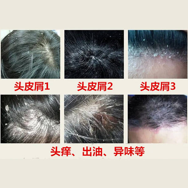 去屑止痒洗发露排行榜_头皮