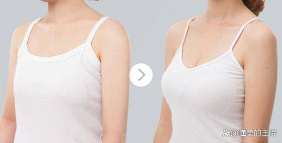 原发性乳腺发育不全是隆乳术的常见适应症之一.