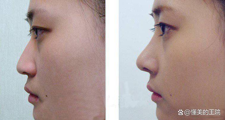 鼻子整形全方位解析手术类型注意事项及恢复指南