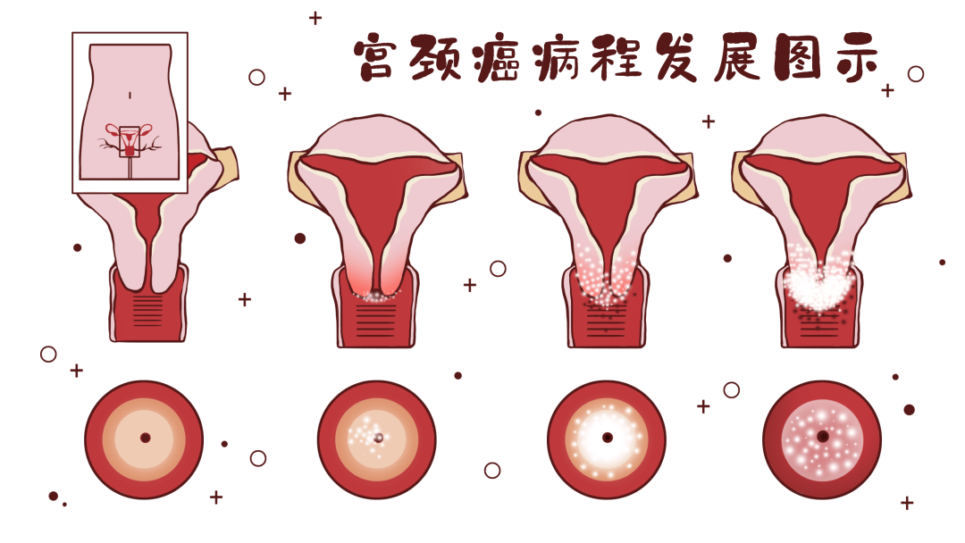 走出认识误区,远离宫颈癌_女性_疫苗_接种