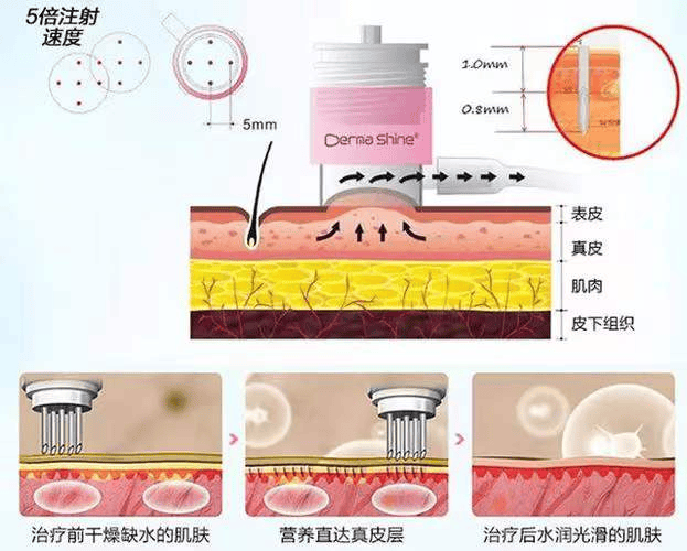 水光针注射层次 图解图片