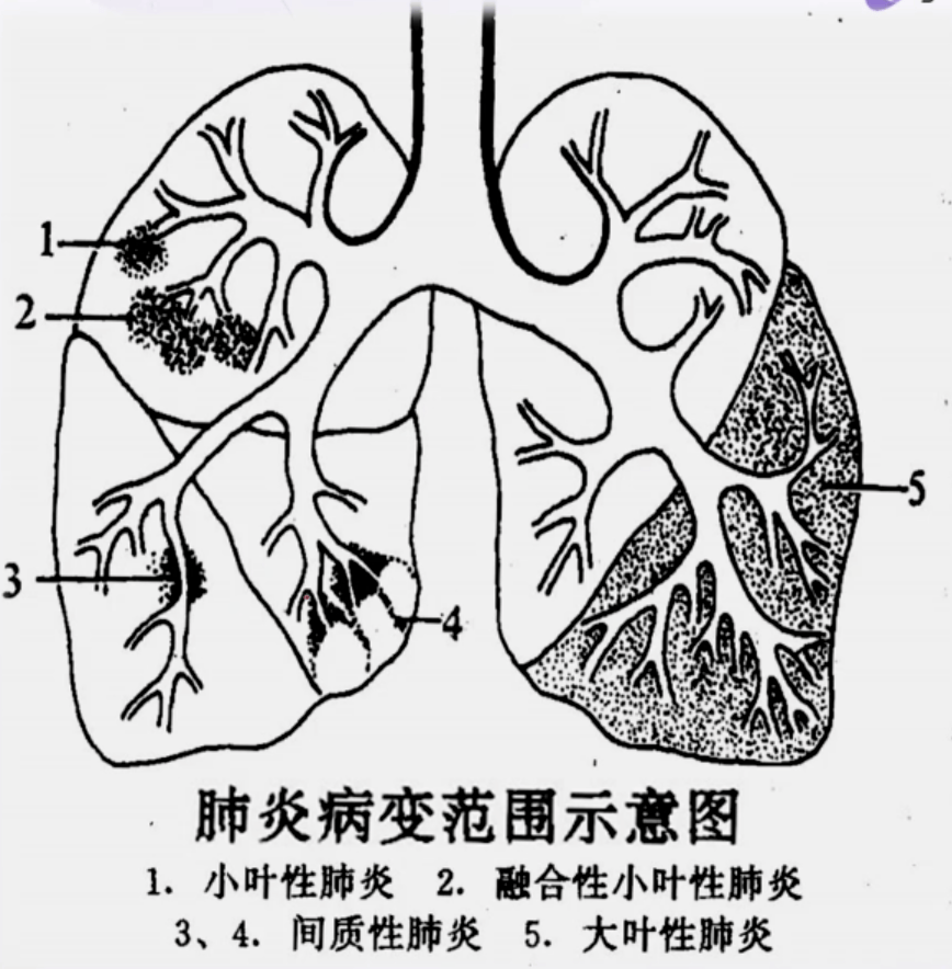 肺炎双球菌图片手绘图图片