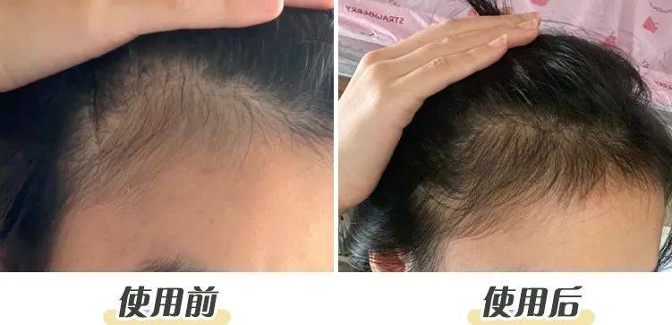 头发_头皮_效果