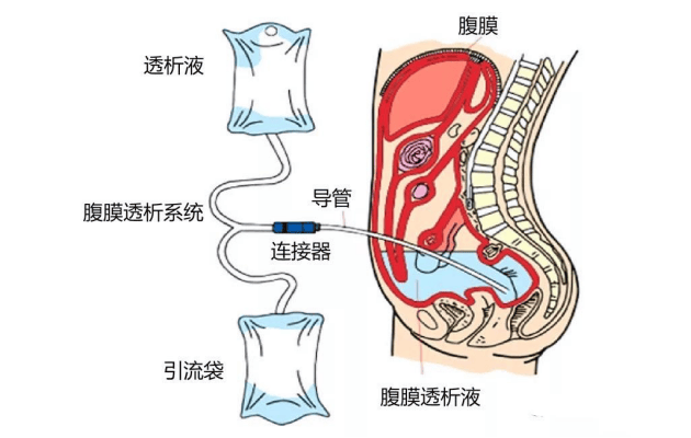 腹膜透析图解图片