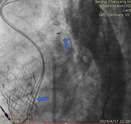 【朝医新闻】心脏中心实施一站式经导管主动脉瓣置换联合动脉导管未闭封堵术手术