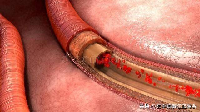 yilmazonalhybrid008微导丝在远端中等血管栓塞病例中的应用