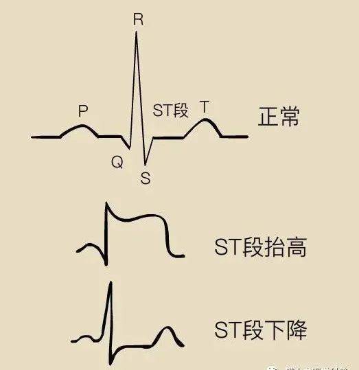 心电图等电位线消失图片