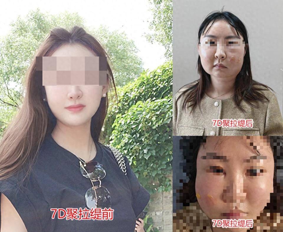 女子在整形医院做“聚拉缇”，变美不成却被烧伤