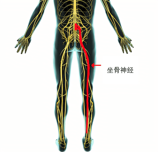 腰突症毛病在腰,为什么会坐骨神经痛?