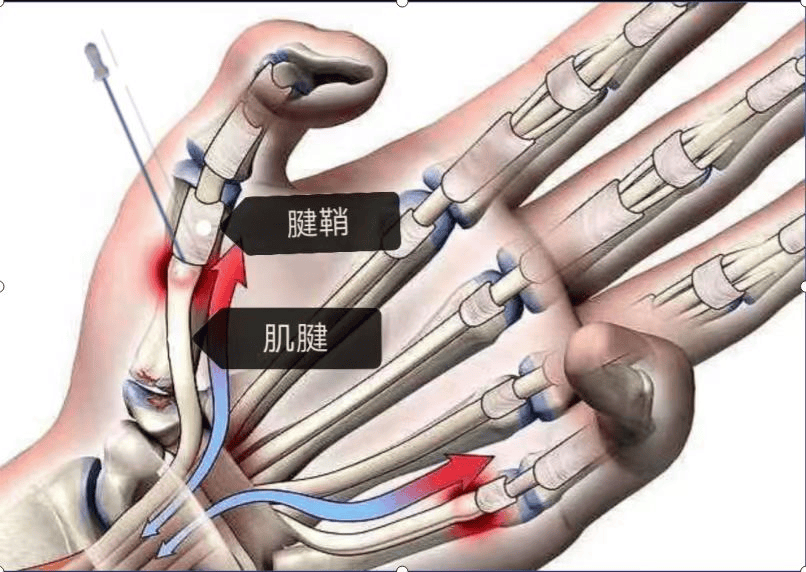 狭窄性腱鞘炎手术步骤图片