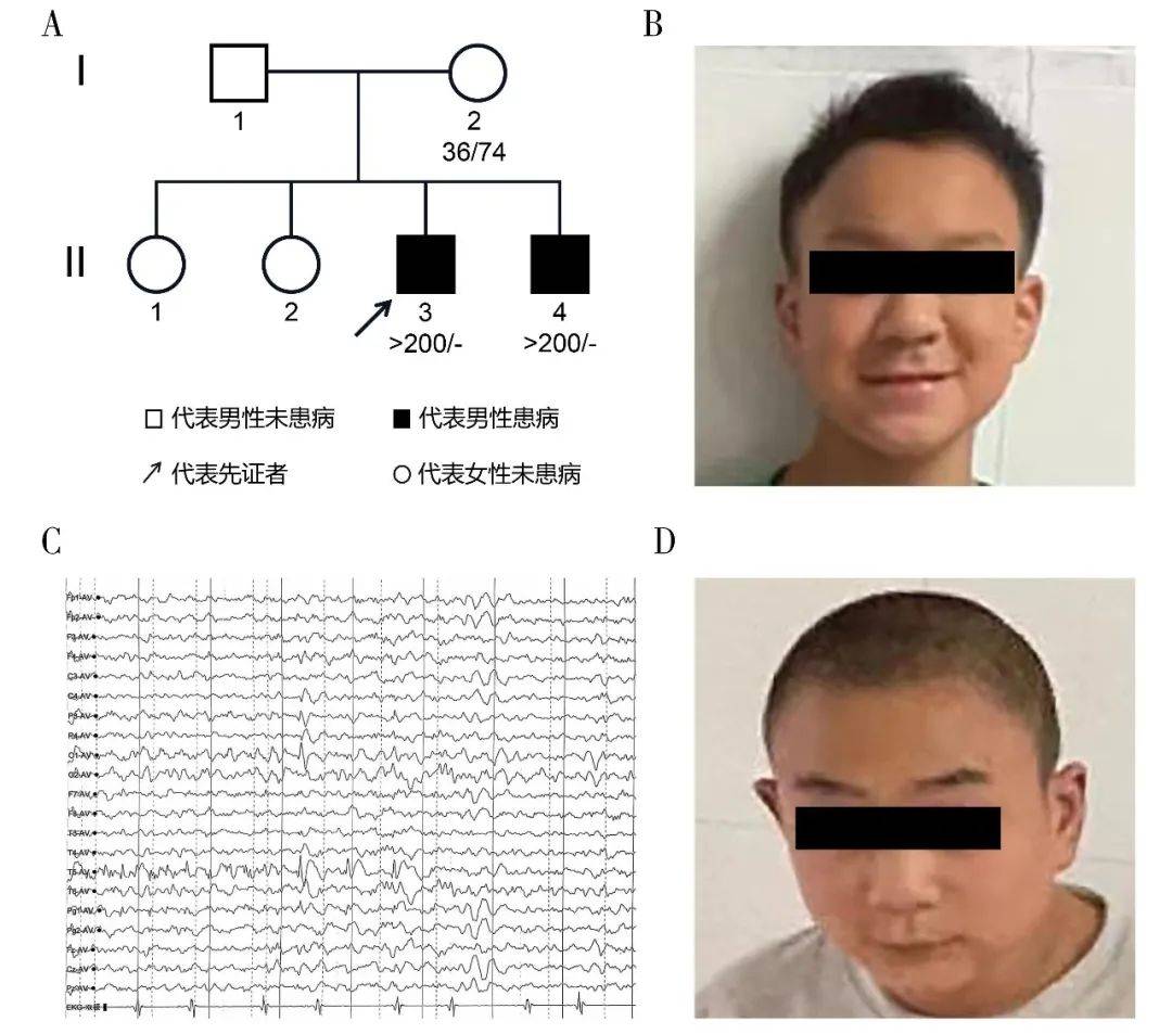 病例报告|伴有癫痫的脆性x综合征家系1例