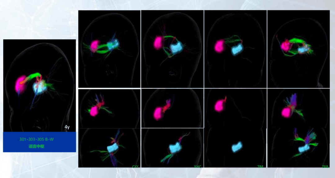 博医来特约 | 任廷文博士:如何应用脑图谱ai软件 通