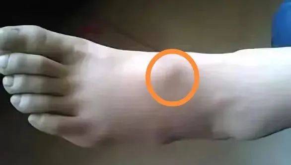 儿医小课堂 215 | 手腕出现小鼓包?警惕儿童腱鞘囊肿