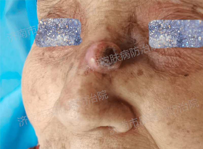 知名专家 | 容易被忽视的皮肤癌前病变——日光性角化病