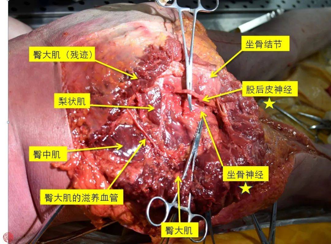 医学笔记︱15分钟掌握臀后入路的解剖步骤(锋哥推荐)