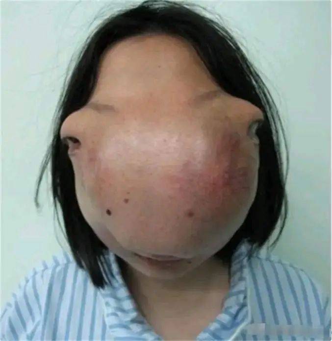 面部长肉瘤图片图片