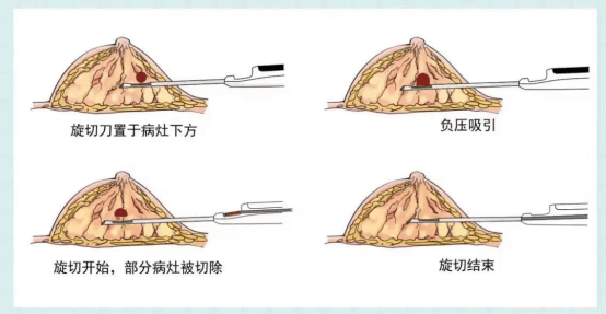 乳腺纤维瘤旋切术图片