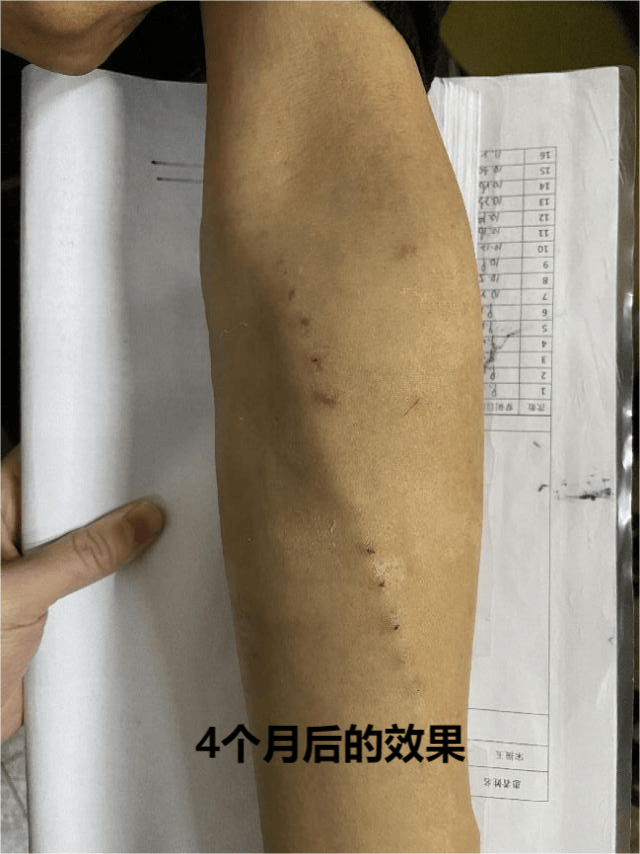 一科一品 | 血液透析室:67舞动"生命线" 让生命永不停"析"