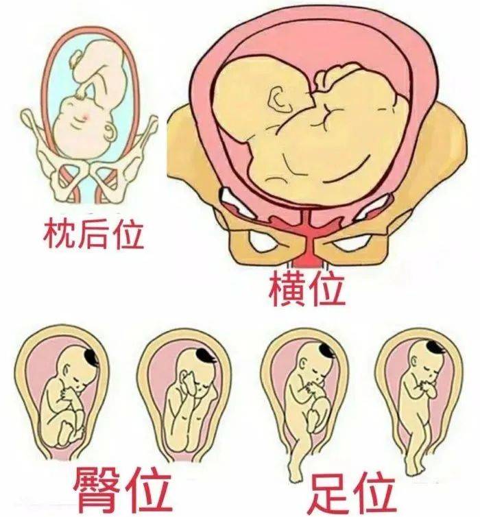 胎位不正,顾名思义,是指胎儿在子宫内的位置不正常,可以是横位,臀位或