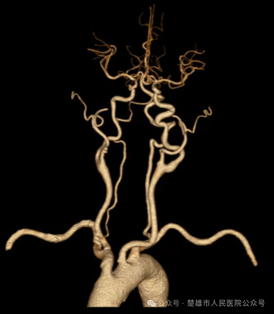 我院成功完成首例全脑血管造影术(dsa)