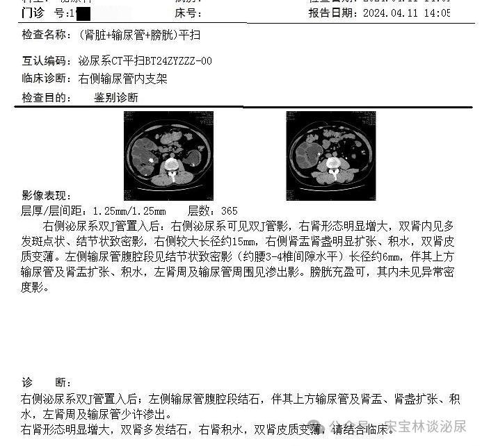 急求同行支招:双j管留置8年,双肾,输尿管多发结石