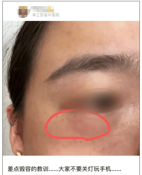 一女子眼皮溃烂冲上热搜!很多人曾中招,饶平特别多