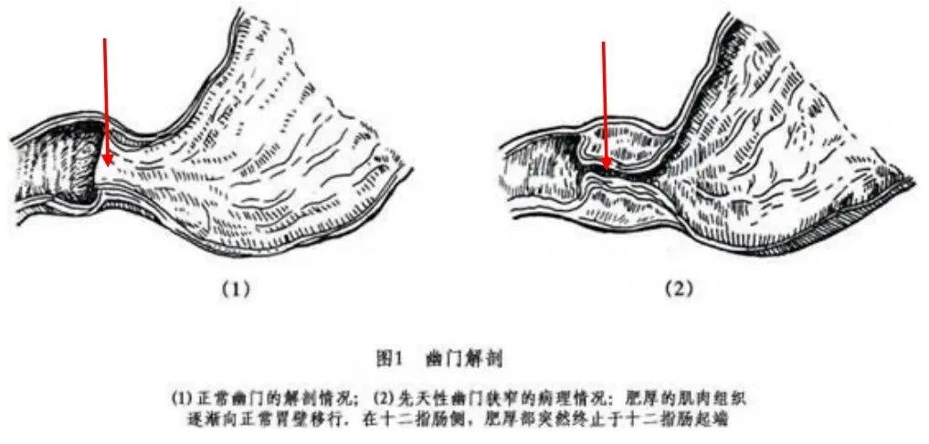 肥厚性幽门狭窄的病因?