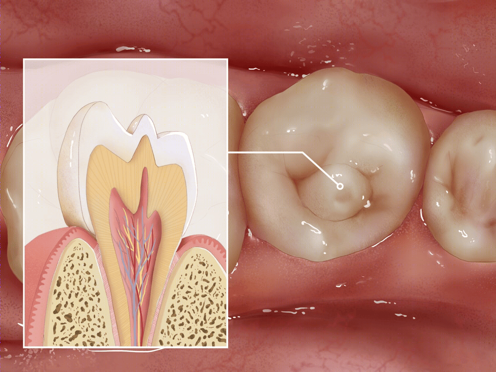 畸形中央尖属于发育畸形,多见于下颌前磨牙,以第二前磨牙最多见