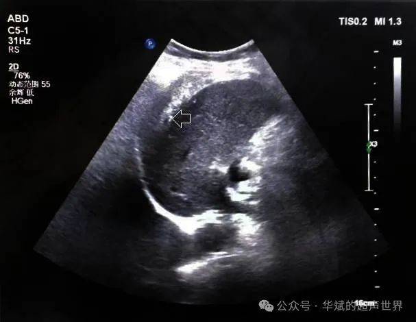 ​肝右叶束状偏强回声,考虑什么?