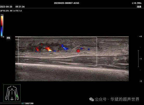前臂血栓性浅静脉炎的超声表现