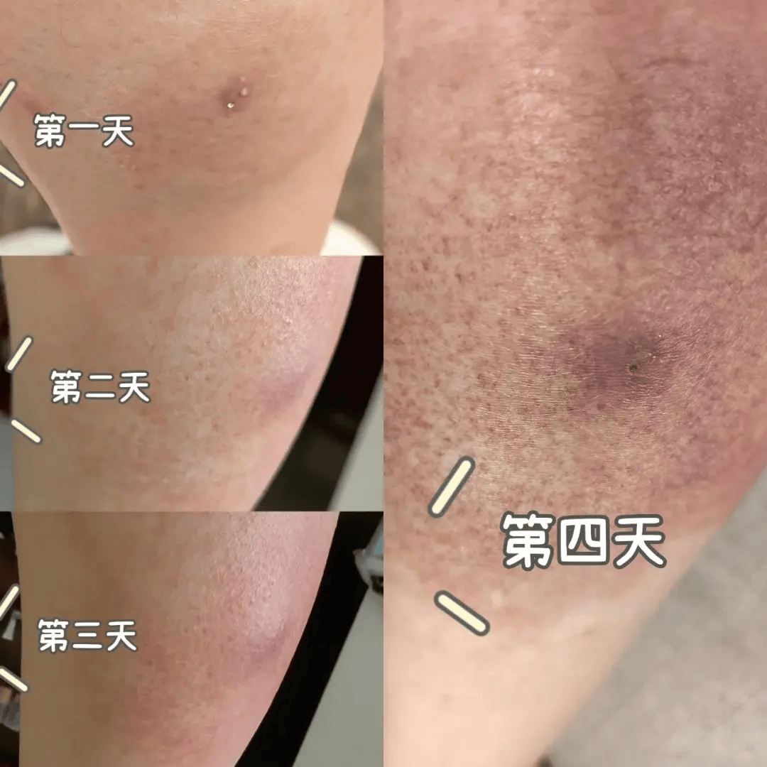 有着相似经历的广东居民吴女士介绍,自己是在树下不幸被红火蚁咬伤