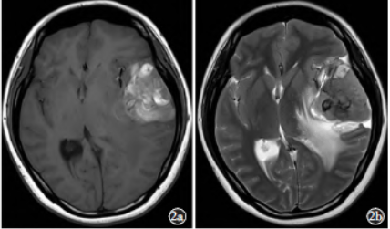 脑膜原发性恶性黑色素瘤一例