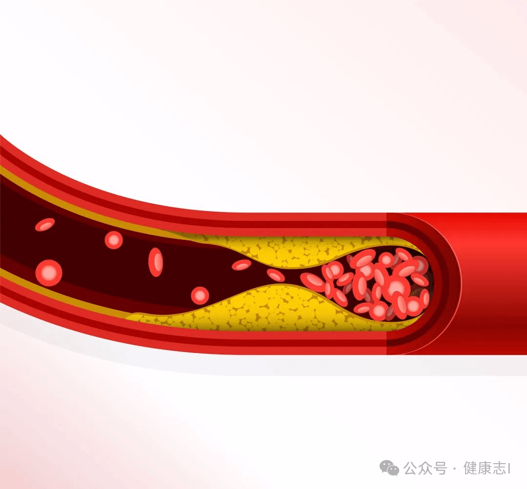 血栓“大户”来袭!不是肥肉,医生:想保护血管,建议远离_食品_风险