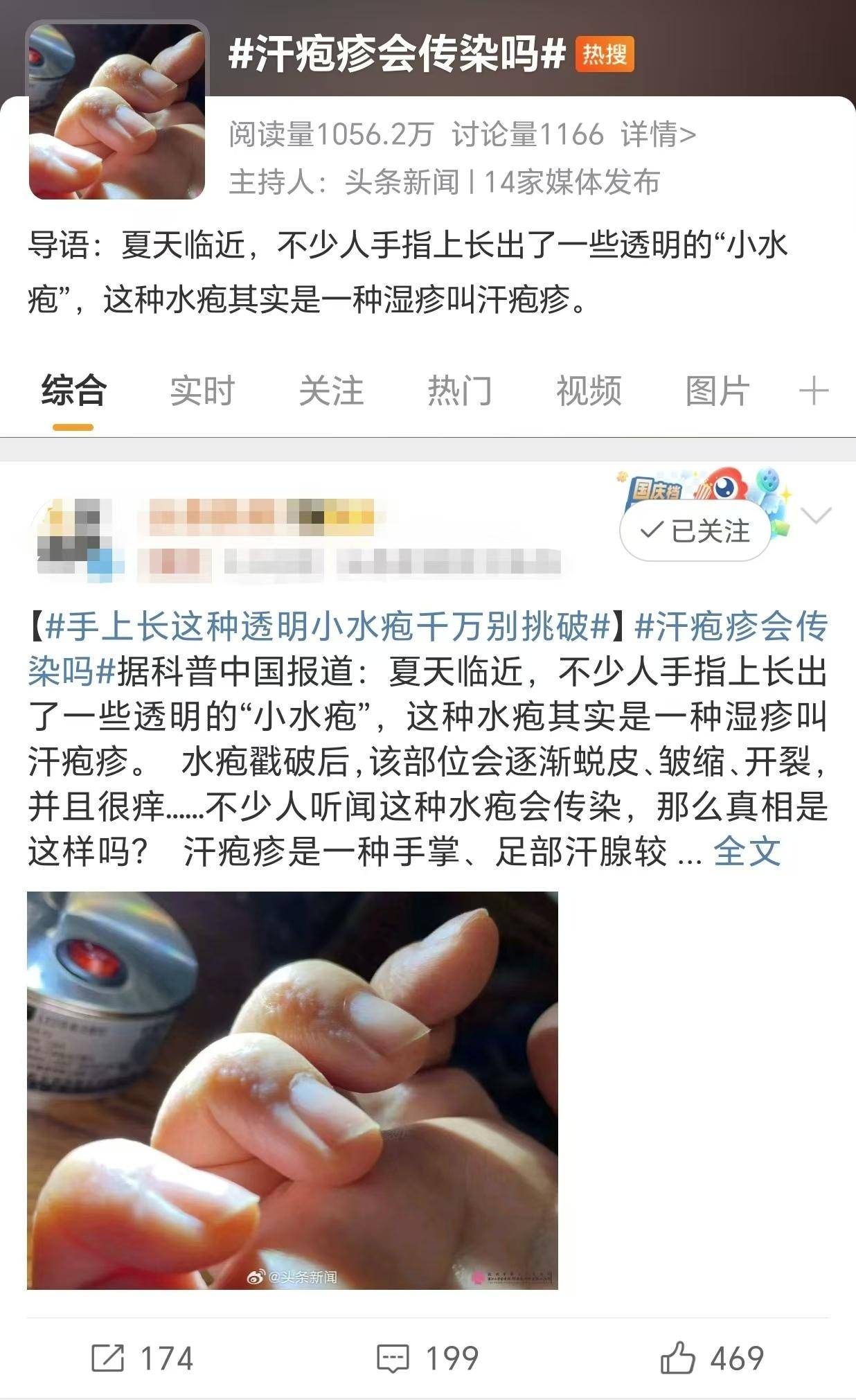 夏天手上长"小水疱" 又痒又疼的汗疱疹真会传染?