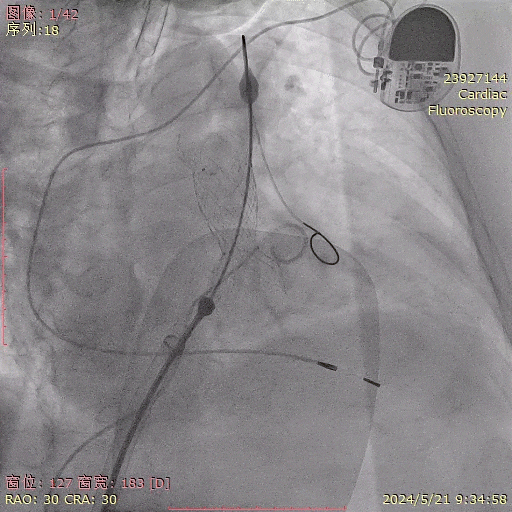 venusp-valve瓣膜释放完成,位置准确,瓣架形态稍受限将输送器送至肺