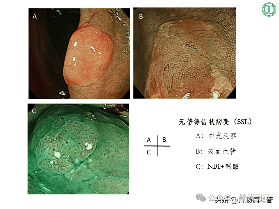 良性的结肠息肉图片图片